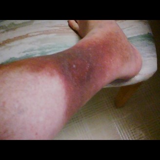 A leg with extensive red and purple bruising on the lower part, its skin stark against the vivid hues, resting on a stool.