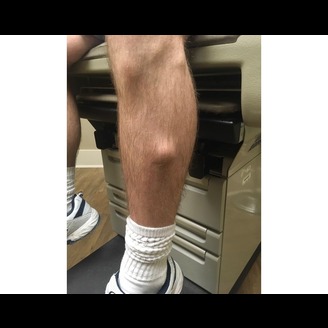 A person with a focus on their knees sits on a medical examination table, wearing white socks and sneakers, possibly preparing for a leg mass assessment.