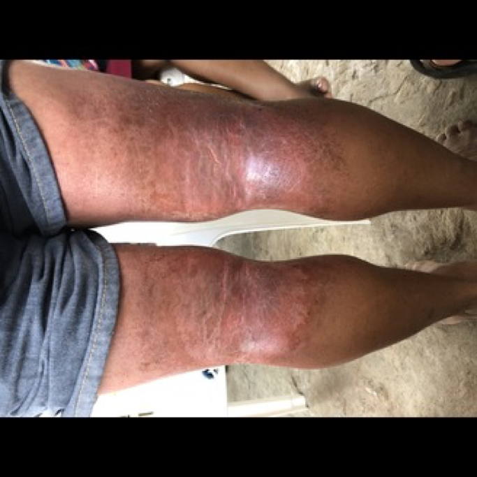 A person's legs, showing a popliteal rash with visible skin irritation and redness, are pictured while they're sitting on a chair wearing shorts.